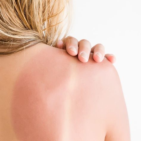 Sunburn