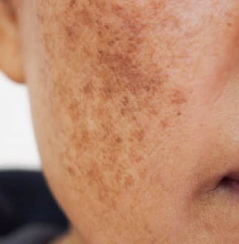 Dark Spots & Pigmentation